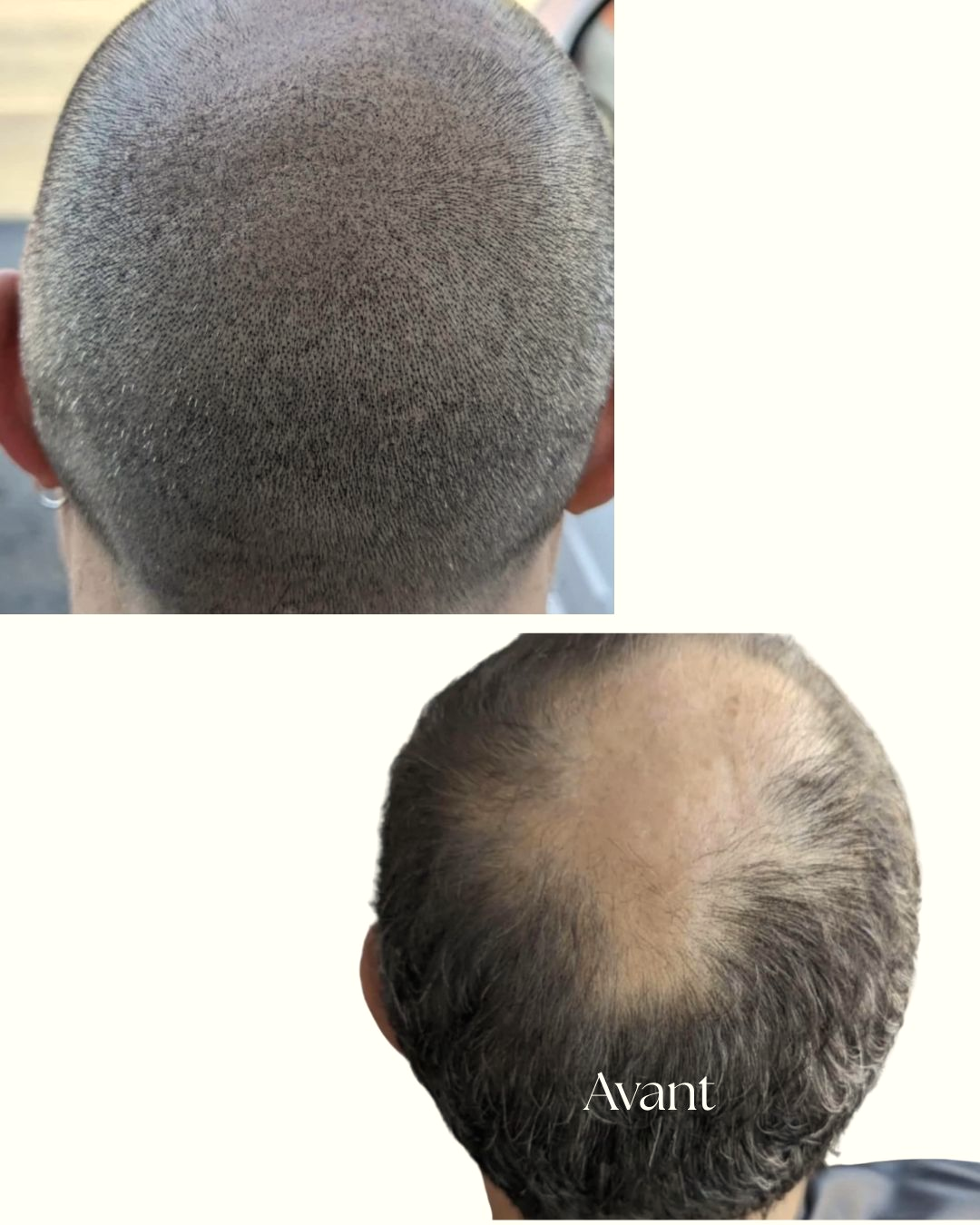 Comparaison avant et après une tricopigmentation dans une présentation ivoire et champagne